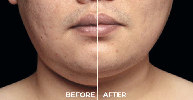 CoolSculpting Elite Before and After on neck area.